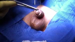Penile Torsion Repair Surgery: What to Expect and Understand